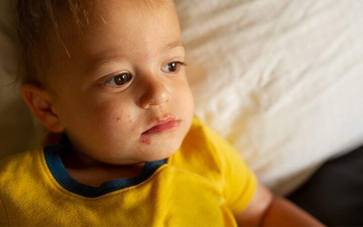 Child with a facial rash