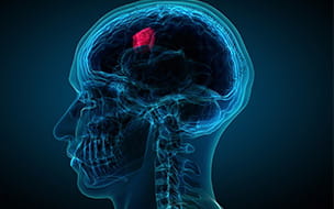 How Coloring Brain Tumors Pink Can Help Cancer Patients Live Longer