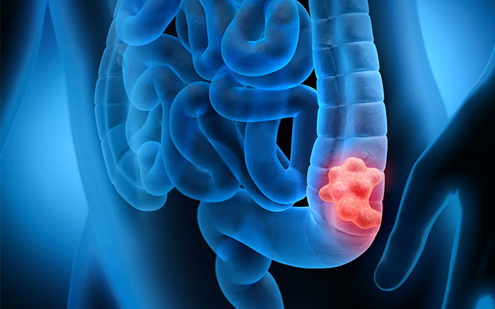 colorectal cancer