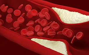 Coronary Calcium Score Test: A Tool To Clarify Heart Disease Risk