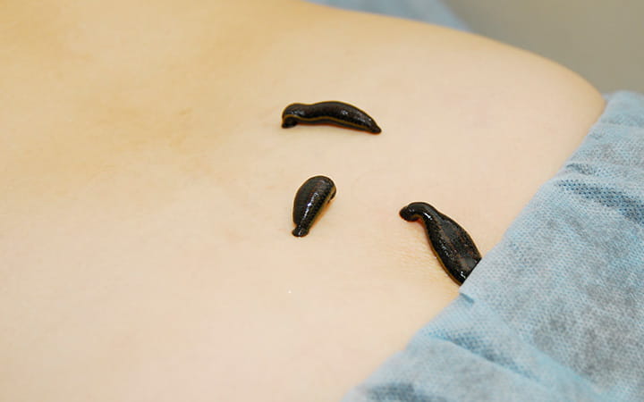 medical leeches
