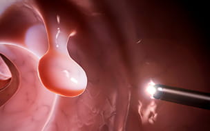 Your Doctor Finds Polyps During a Colonoscopy: What It Means