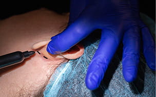 Considering Cosmetic Ear Surgery? The Facts about Otoplasty