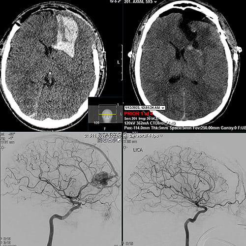 A CT scan of Joshua’s brain showed a ruptured arteriovenous malformation