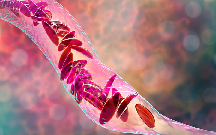 Illustration of sickle cell anemia