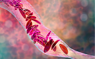 Illustration of sickle cell anemia