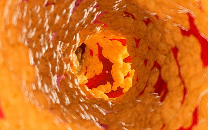 Illustration of fat inside of an artery
