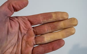 Fingers Turn Blue or White When Cold? It Could be Raynaud’s