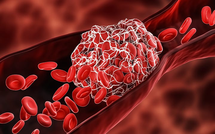 illustration of blood clot