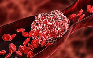 Preventing Deep Vein Thrombosis from Coming Back