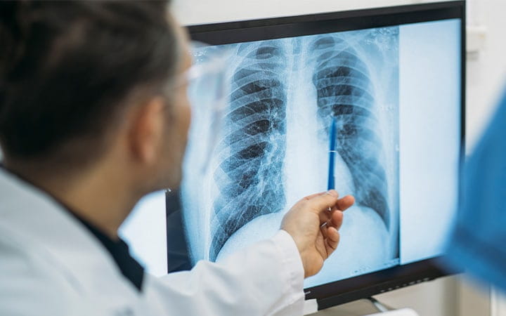 Doctor looks at lung X-ray