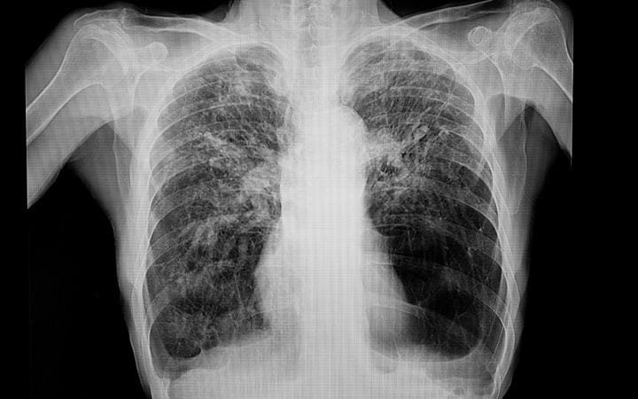 Abnormal chest x-ray