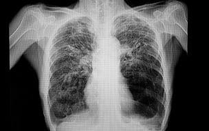 How Common Are Lung Nodules?