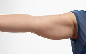 After Weight Loss, Many Face a New Issue: Excess Skin
