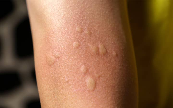 Mosquito bites on an arm
