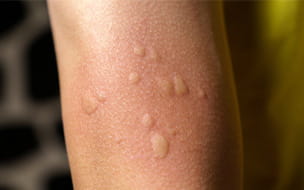 Skeeter Syndrome: When Mosquito Bites Trigger a Serious Reaction