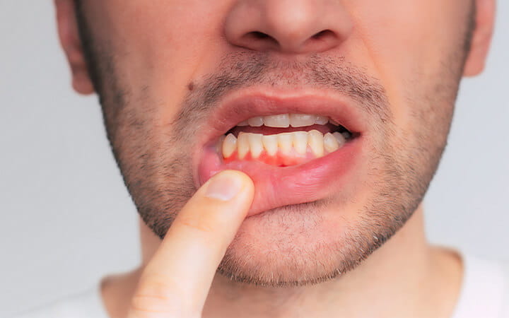 A young man showing red bleeding gums