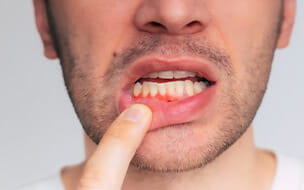 Gum Disease Is Linked to Alzheimer’s and Other Dementias