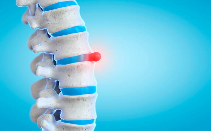 Illustration of a prolapsed spinal disc