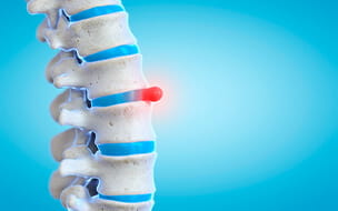 A New Way to Treat Herniated Discs, With Less Pain and Downtime