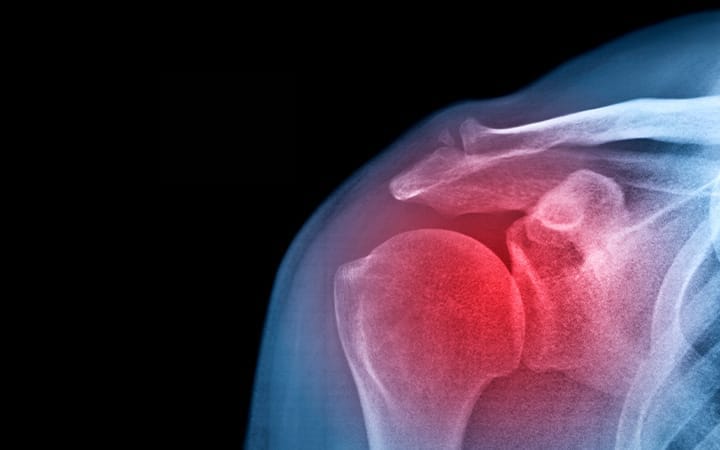 An X-ray showing a frozen shoulder