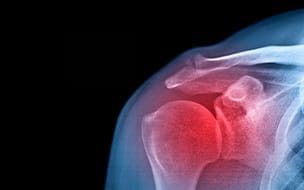 Stiff, Painful Shoulder? It Might Be Frozen Shoulder