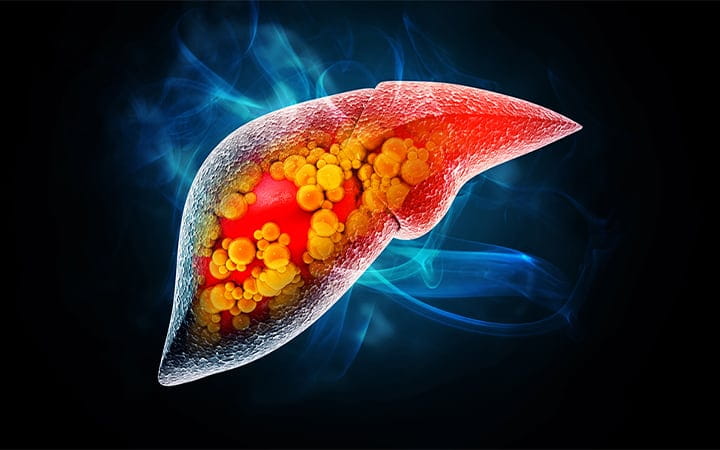 a liver with fat deposits