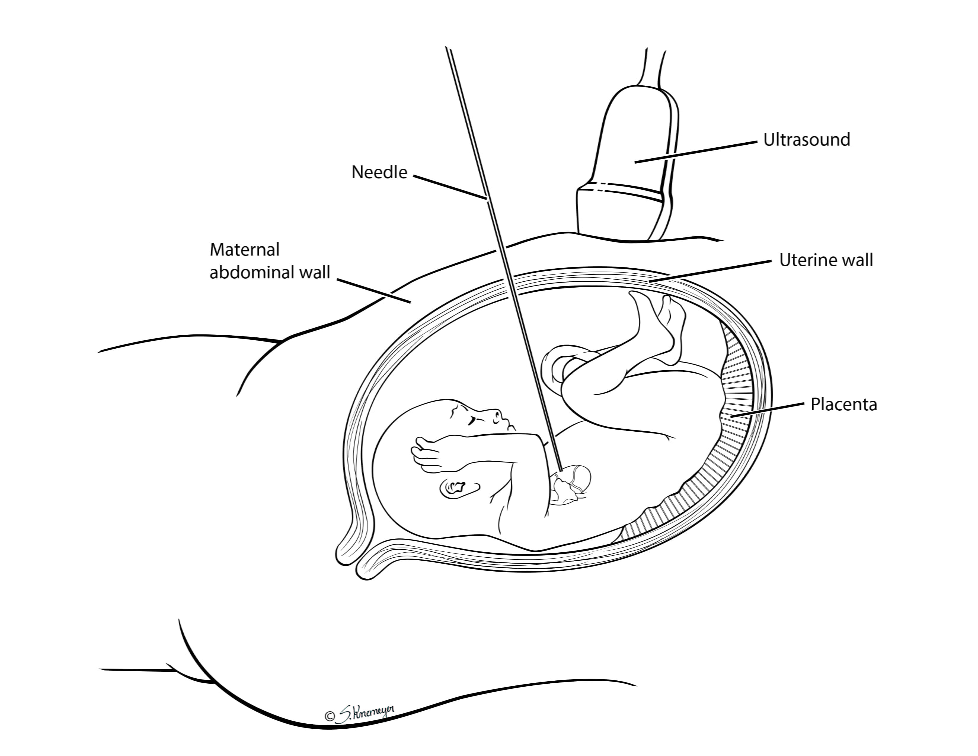 Fetal cardia intervention overview illustation