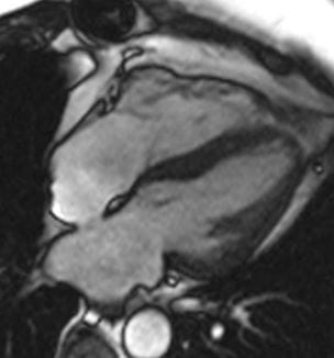 Cardiac MR scan