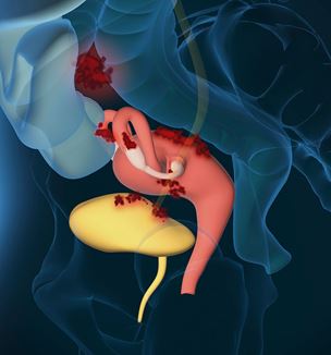Endometriosis illustration