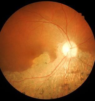 Macular hole image