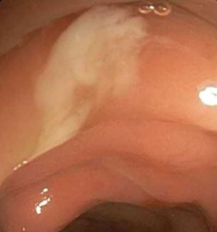 Image of diverticulitis