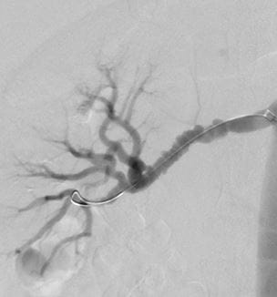 Multifocal FMD