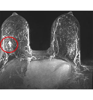 Abbreviated breast MRI scan