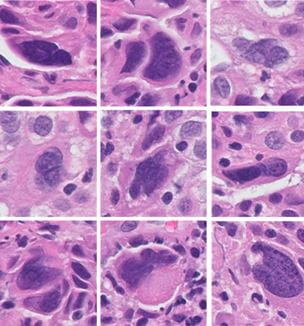 AI Tumor response image