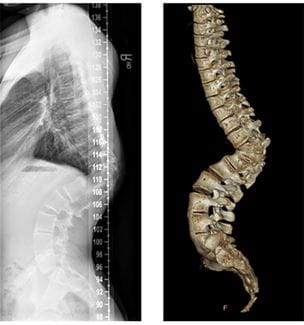 Kyphosis