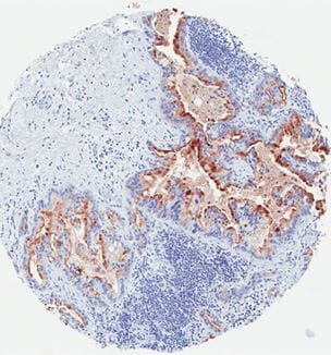 Mesothelin - positive