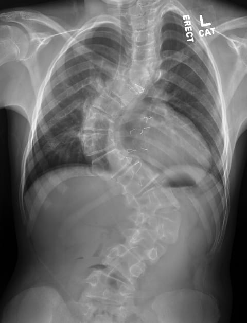 Preoperative scoliosis