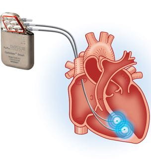 Cardiac Contractility Modulation