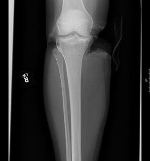 Tibia Fibia Waterskiing trauma