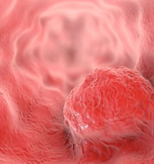Esophagel Cancer Illustration