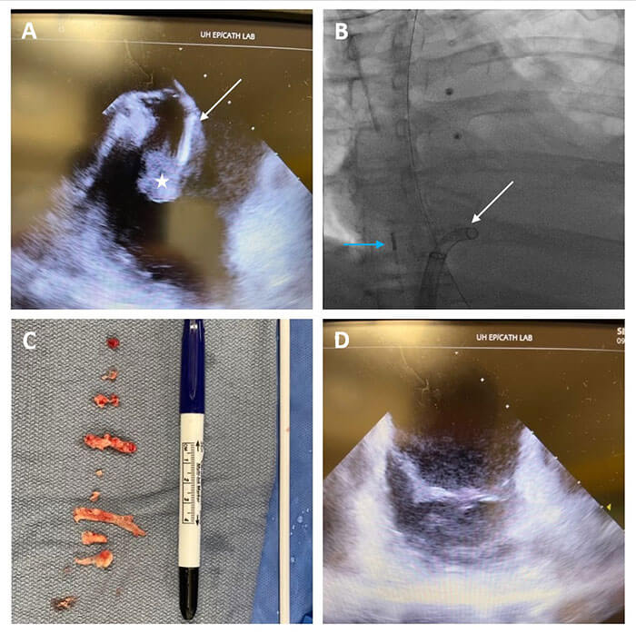 Endocarditis image