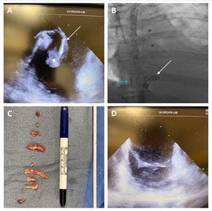 Endocarditis image