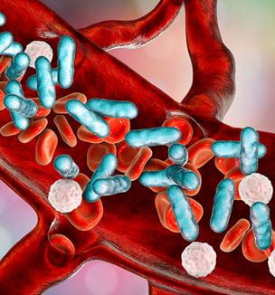 Sepsis illustration