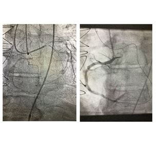 RCA Stent scans
