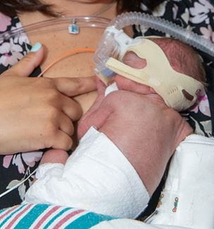 Image of premie with brochopulmonary dysplasia