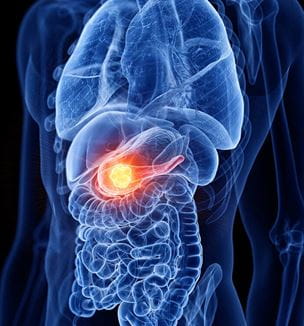 Pancreas cancer illustration