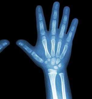 Child hand xray