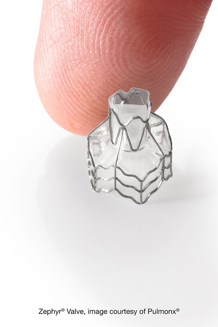 Pulmonx Zephyr Valve