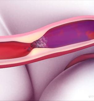 Clot busting tPA illustraion